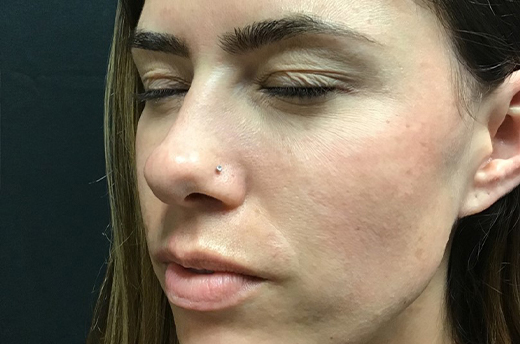 Patient #54162: Dysport After Image