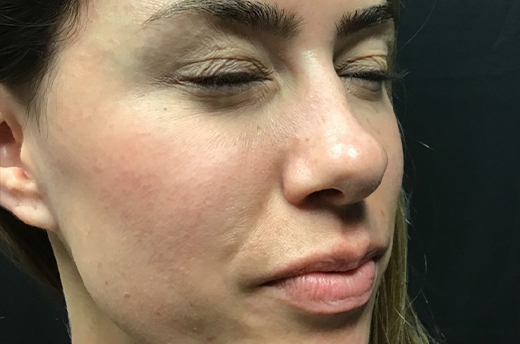 Patient #54162: Dysport After Image