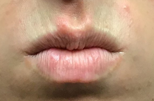 Patient #54162: Dysport Before Image