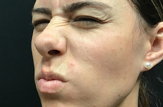 Patient #54162: Dysport Before Image