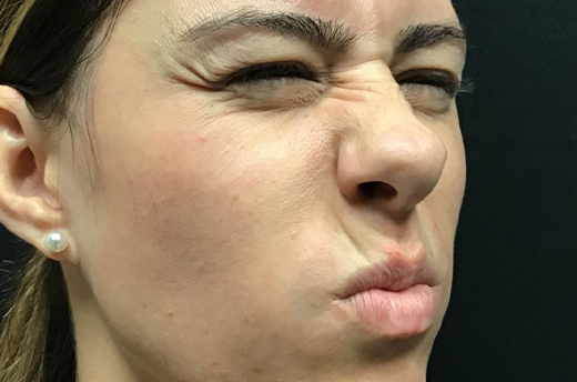 Patient #54162: Dysport Before Image