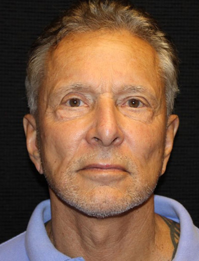 Patient #23422: Facelift After Image