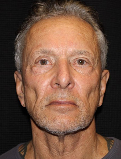 Patient #23422: Facelift Before Image