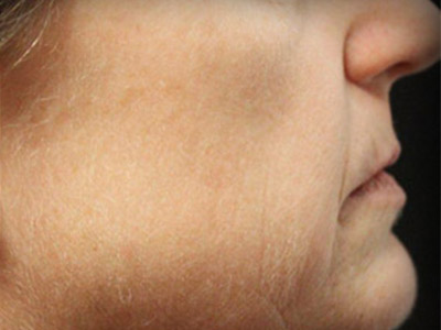 Paciente n.° 82076: Imagen posterior al tratamiento fotofacial