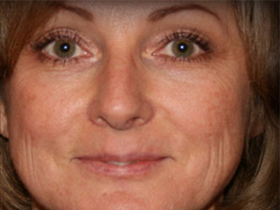Patient #04761: Resurfacing Before Image