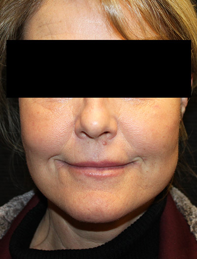 Patient #87252: In-Office Facelift & Fat Injections After Image