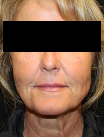Patient #87252: In-Office Facelift & Fat Injections Before Image