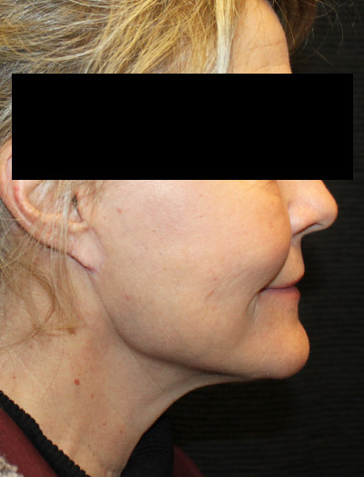 Patient #87252: In-Office Facelift & Fat Injections After Image