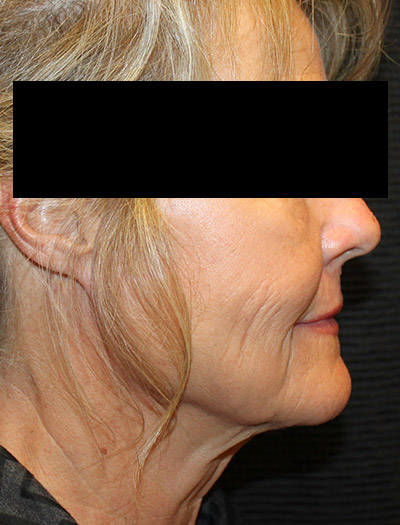 Patient #87252: In-Office Facelift & Fat Injections Before Image