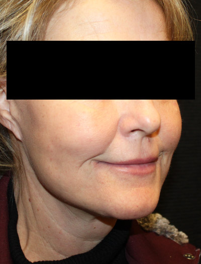 Patient #87252: In-Office Facelift & Fat Injections After Image