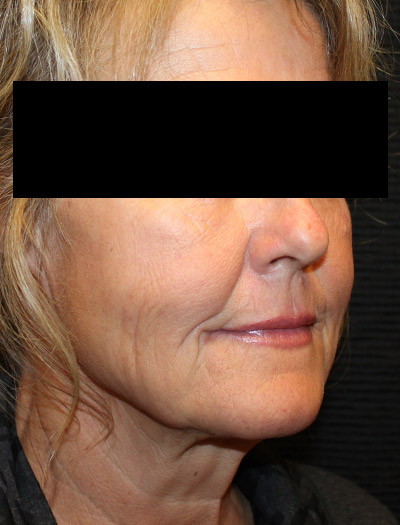 Patient #87252: In-Office Facelift & Fat Injections Before Image