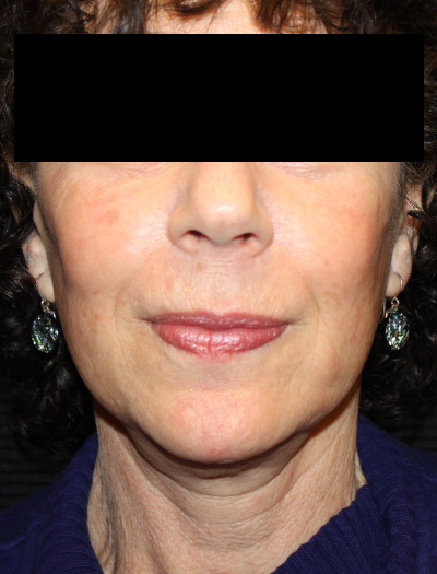Patient #94975: In-Office Facelift After Image