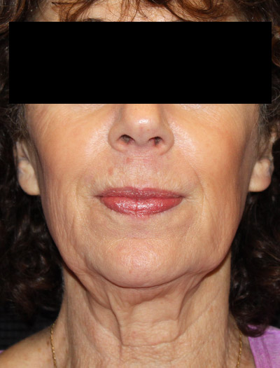 Patient #94975: In-Office Facelift Before Image