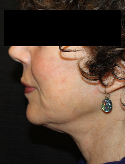Patient #94975: In-Office Facelift After Image