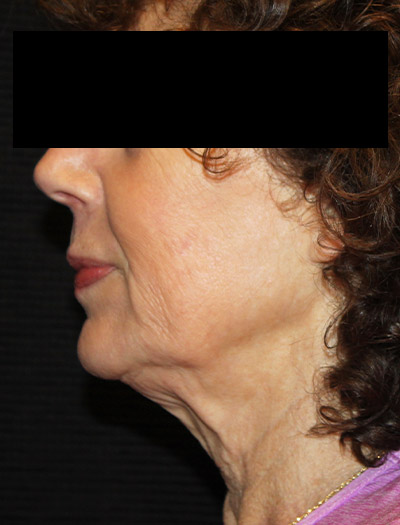 Patient #94975: In-Office Facelift Before Image