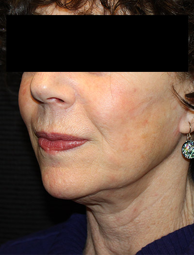 Patient #94975: In-Office Facelift After Image