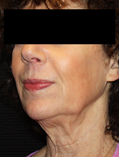 Patient #94975: In-Office Facelift Before Image