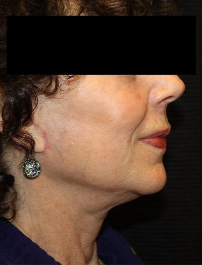 Patient #94975: In-Office Facelift After Image
