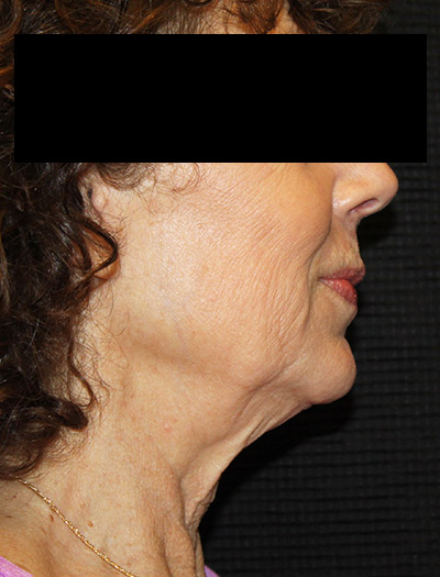 Patient #94975: In-Office Facelift Before Image