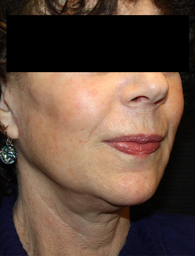 Patient #94975: In-Office Facelift After Image