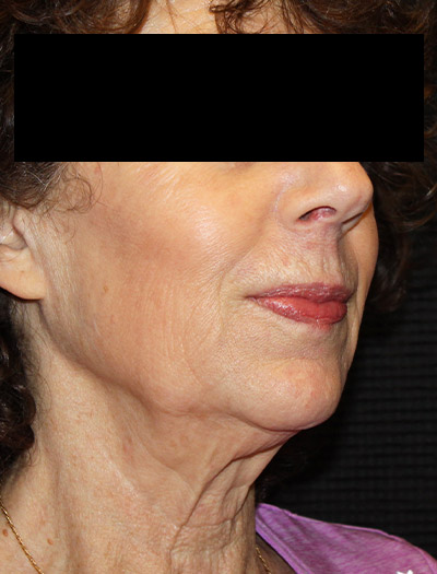 Patient #94975: In-Office Facelift Before Image