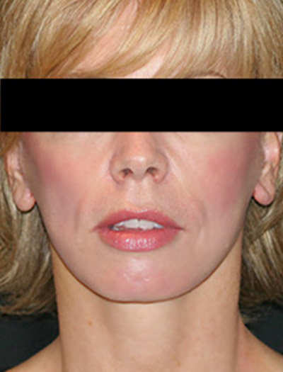 Patient #36023: In-Office Facelift After Image