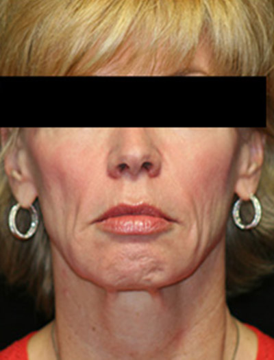 Patient #36023: In-Office Facelift Before Image