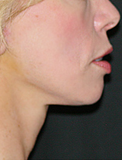 Patient #36023: In-Office Facelift After Image