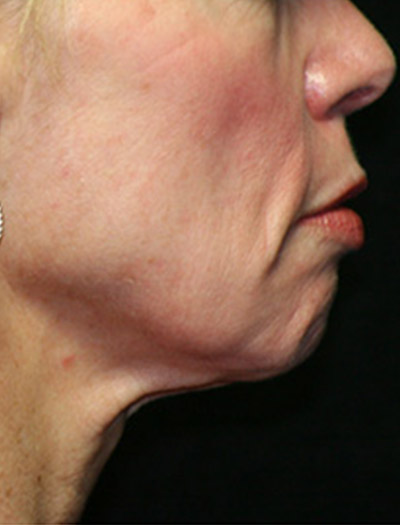 Patient #36023: In-Office Facelift Before Image