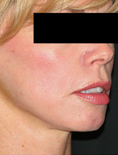 Patient #36023: In-Office Facelift After Image