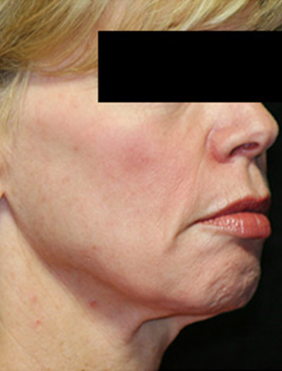 Patient #36023: In-Office Facelift Before Image