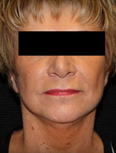 Patient #49613: In-Office Facelift After Image