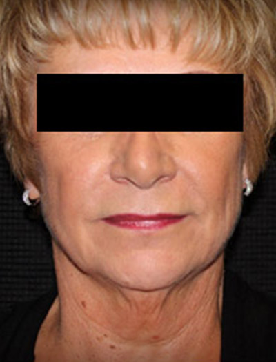 Patient #49613: In-Office Facelift Before Image