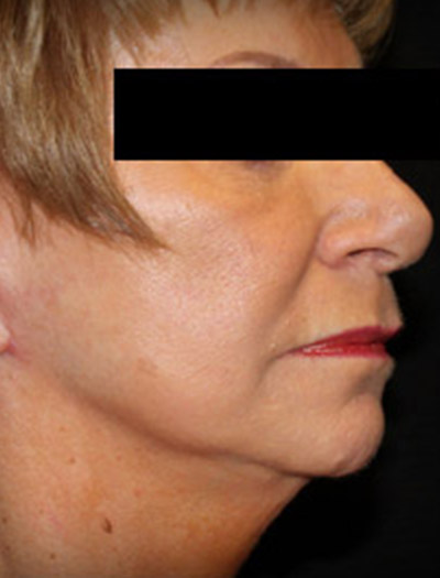 Patient #49613: In-Office Facelift After Image