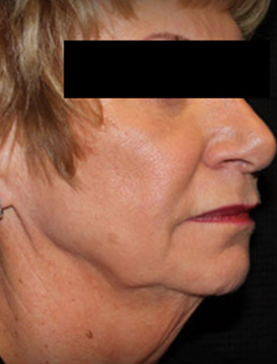 Patient #49613: In-Office Facelift Before Image