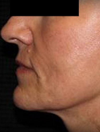 Patient #25903: In-Office Facelift After Image