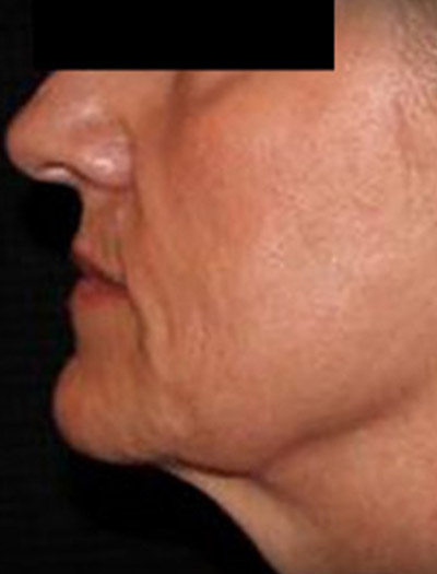 Patient #25903: In-Office Facelift Before Image