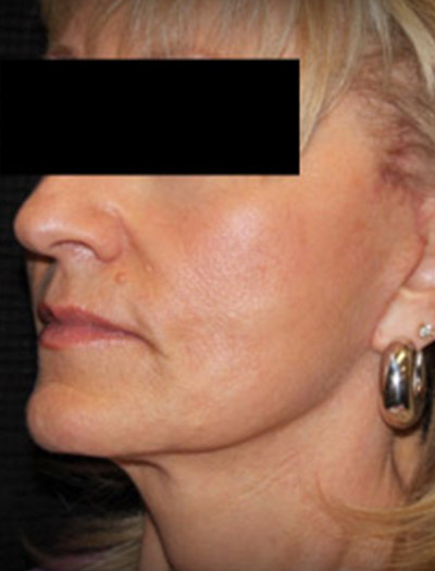 Patient #25903: In-Office Facelift After Image