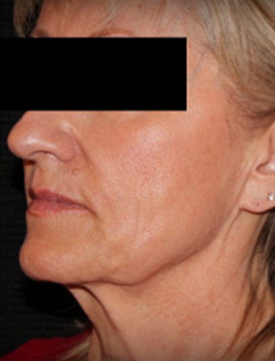 Patient #25903: In-Office Facelift Before Image