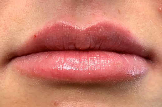 Patient #14969: Juvéderm After Image