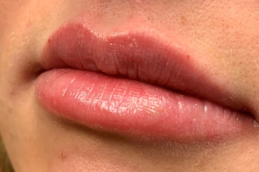 Patient #14969: Juvéderm After Image