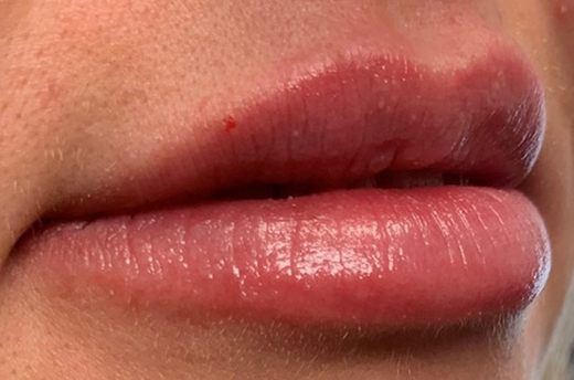 Patient #14969: Juvéderm After Image