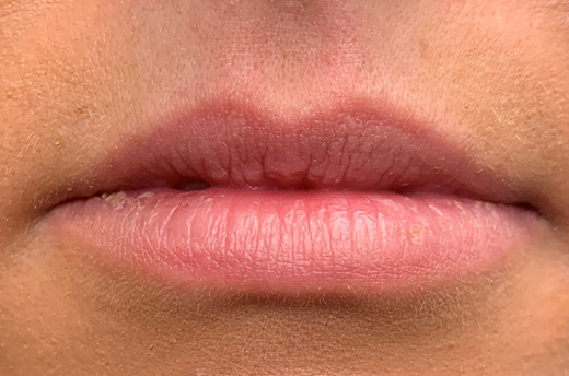 Patient #14969: Juvéderm Before Image