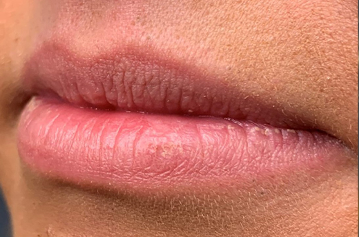 Patient #14969: Juvéderm Before Image