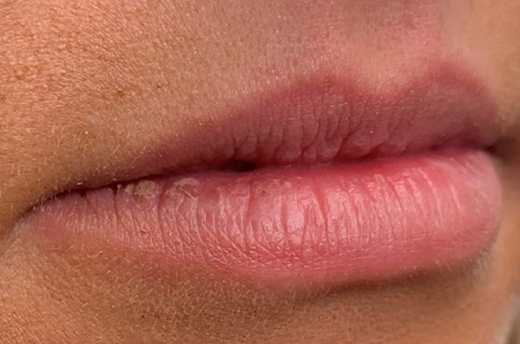 Patient #14969: Juvéderm Before Image