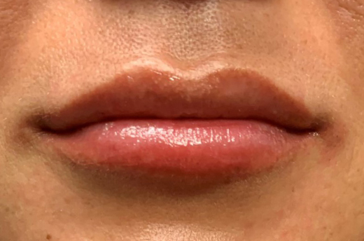 Patient #51160: Juvéderm Ultra After Image