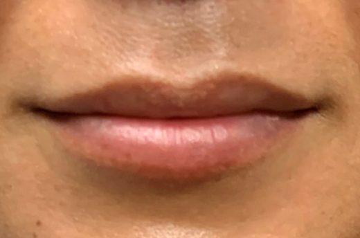 Patient #51160: Juvéderm Ultra Before Image