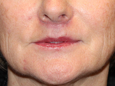 Paciente n.° 37920: Imagen posterior al lifting de labios