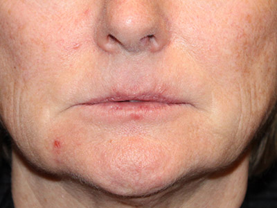 Paciente n.° 37920: Imagen previa al lifting de labios