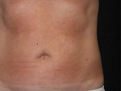 Patient #86533: Liposuction After Image